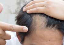 Los 5 remedios sorprendentes que detienen la caida del cabello